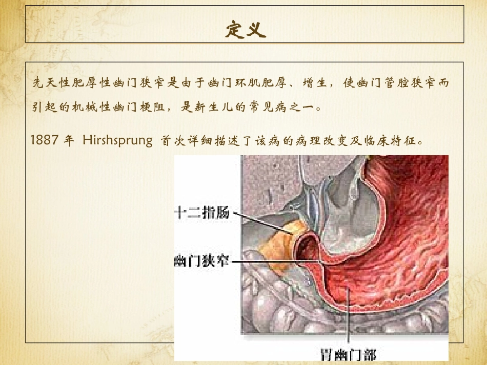 先天性肥厚性幽门狭窄讲义_第2页