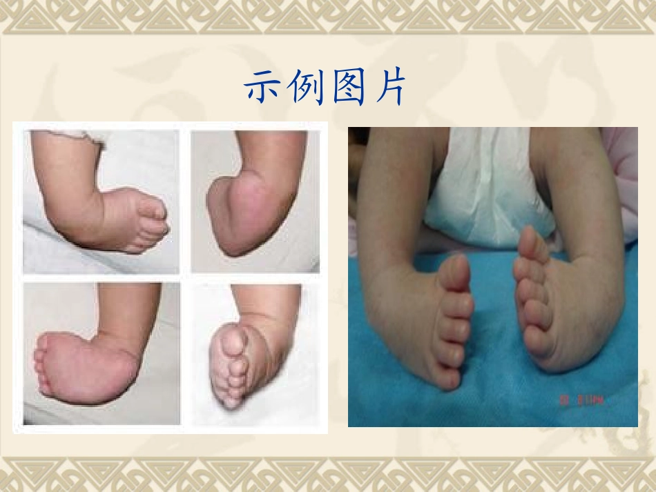 先天性马蹄内翻足_第2页