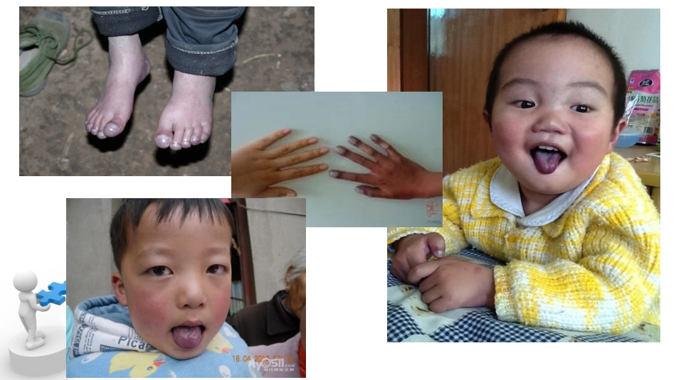 先天性心脏病合并肺炎的护理_第2页