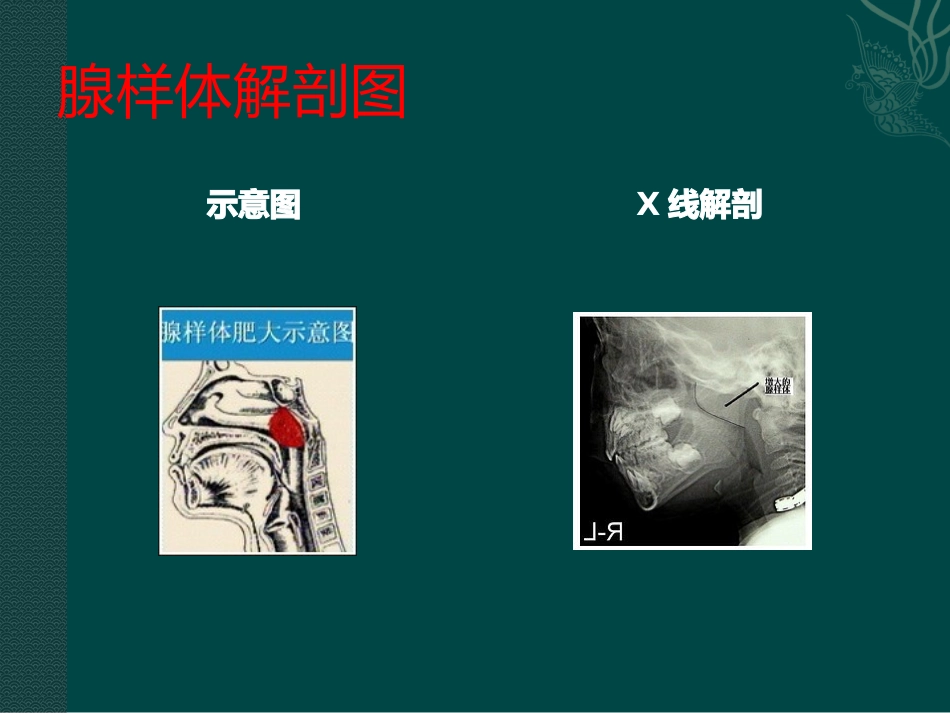 腺样体肥大X线诊断_第3页