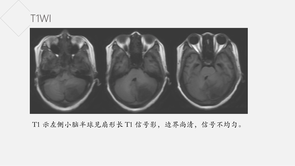 小脑发育不良节细胞瘤_第3页