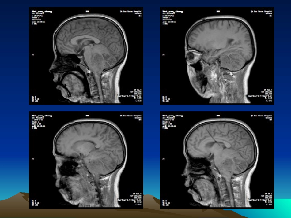 小脑发育不良性节细胞瘤概述_第2页
