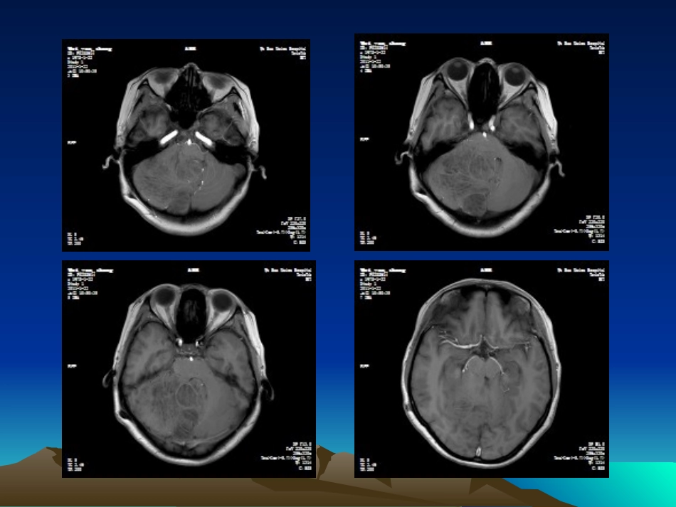 小脑发育不良性节细胞瘤概述_第3页