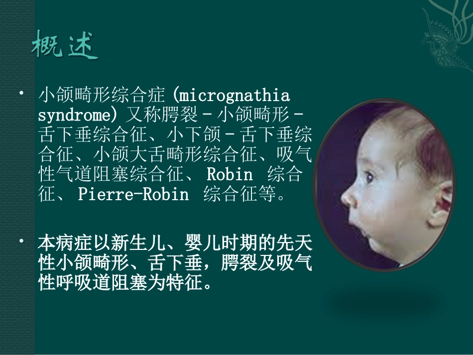 小下颌畸形综合征_第2页