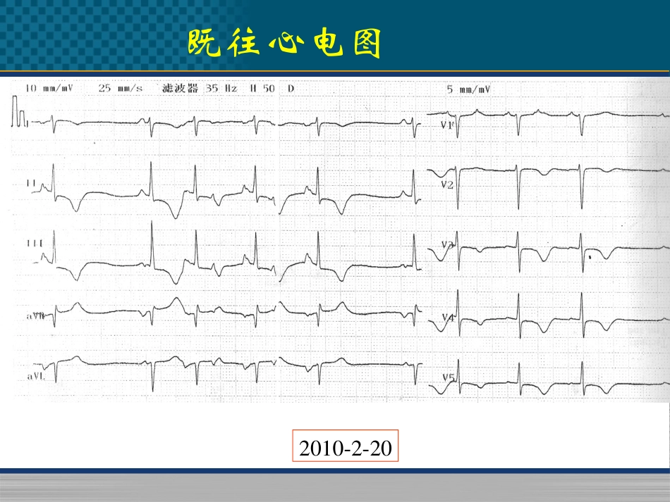 心律失常病例_第2页