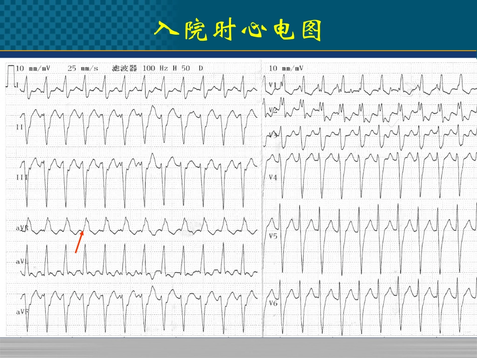 心律失常病例_第3页