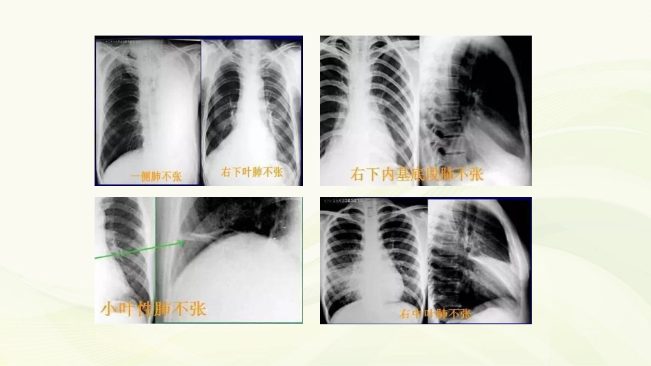 胸部常见病变的X线表现_第3页