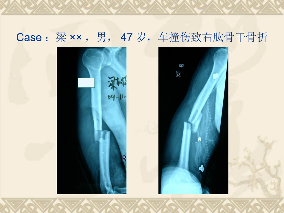 医学MIPO技术治疗肱骨干中段骨折课件_第2页