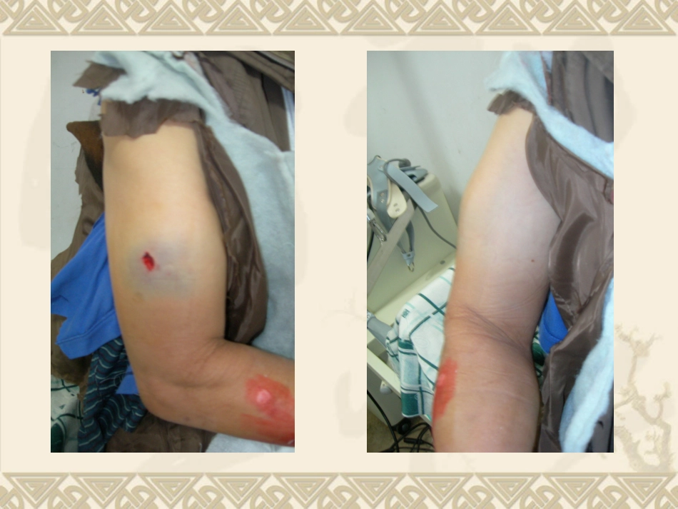 医学MIPO技术治疗肱骨干中段骨折课件_第3页