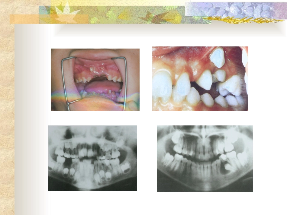 医学乳牙根管治疗培训课件_第3页