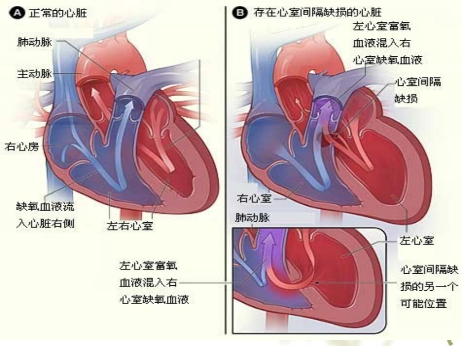 医学室间隔缺损术后护理课件_第3页