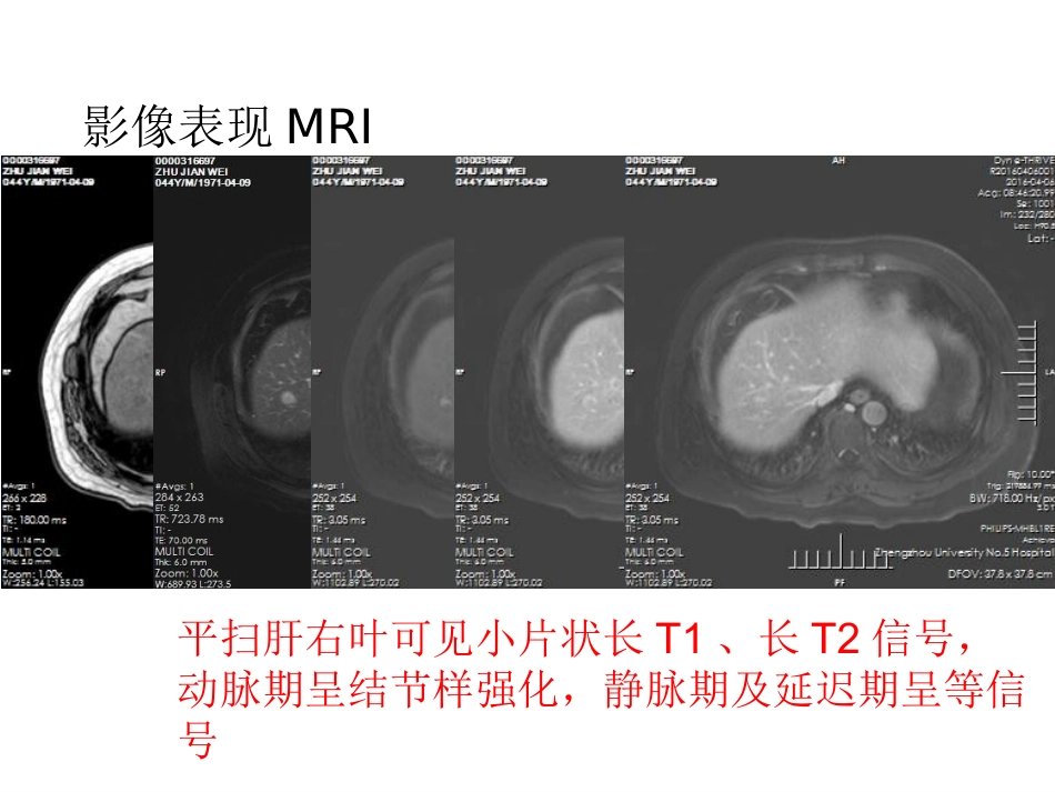 医学影像病例讨论肝细胞肝癌_第3页