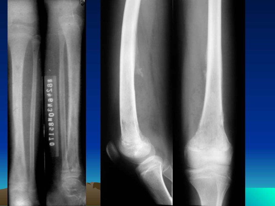 医学影像学化脓性骨髓炎影像表现_第3页