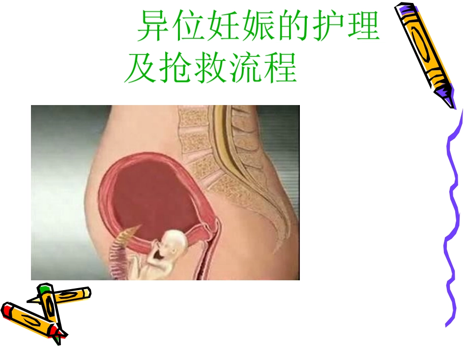 异位妊娠的护理及抢救流程_第1页