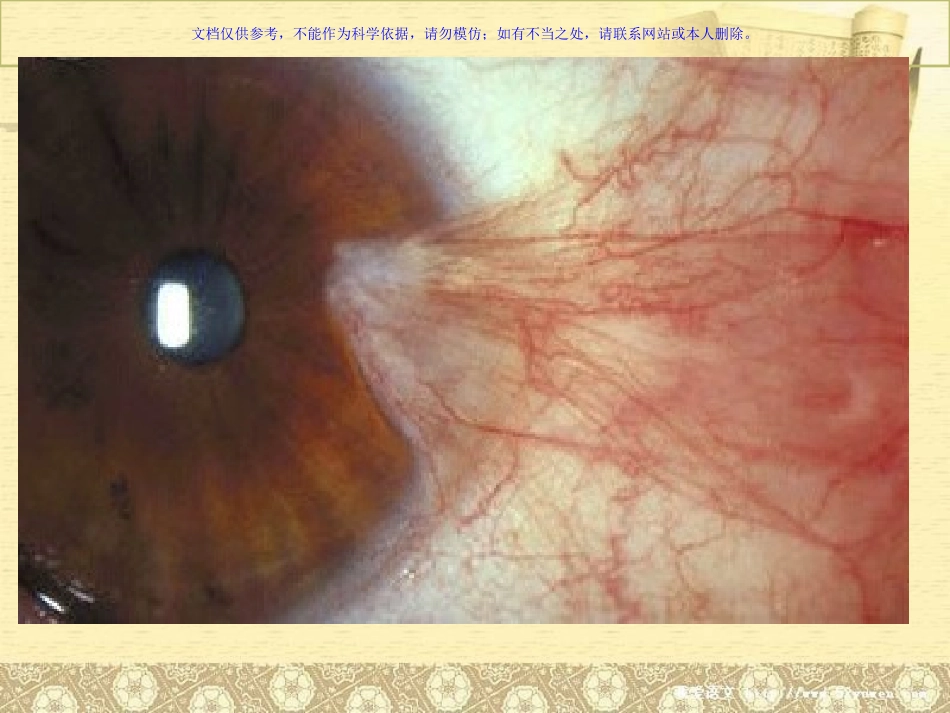 翼状胬肉的专题宣讲课件_第2页
