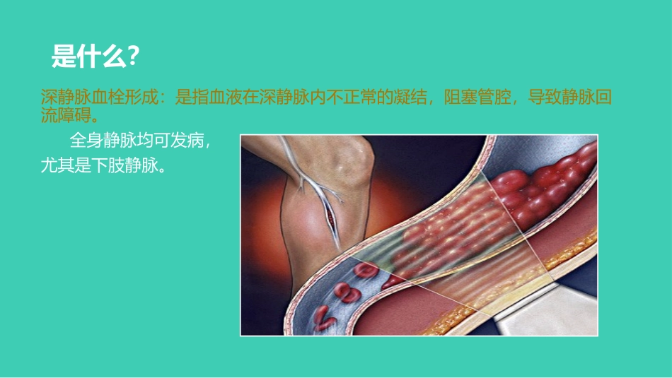 预防深静脉血栓宣教_第3页