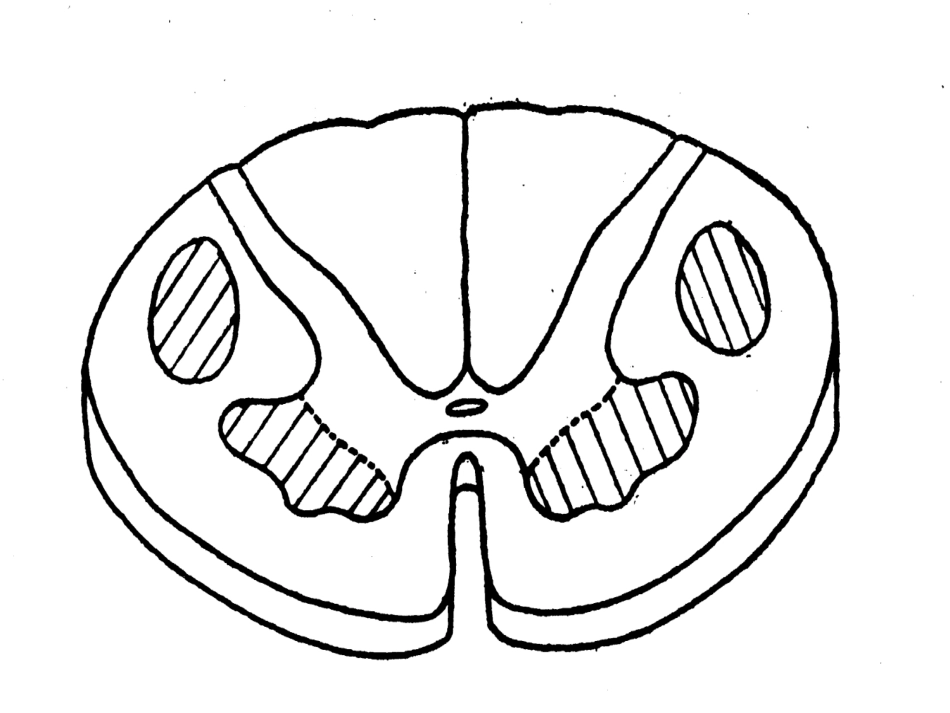运动神经元病讲解_第2页