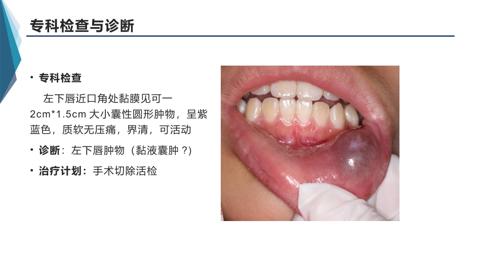 粘液囊肿病例_第3页