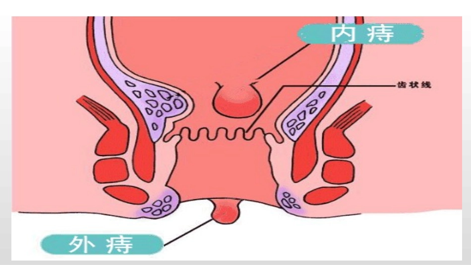 痔疮的护理常规_第3页