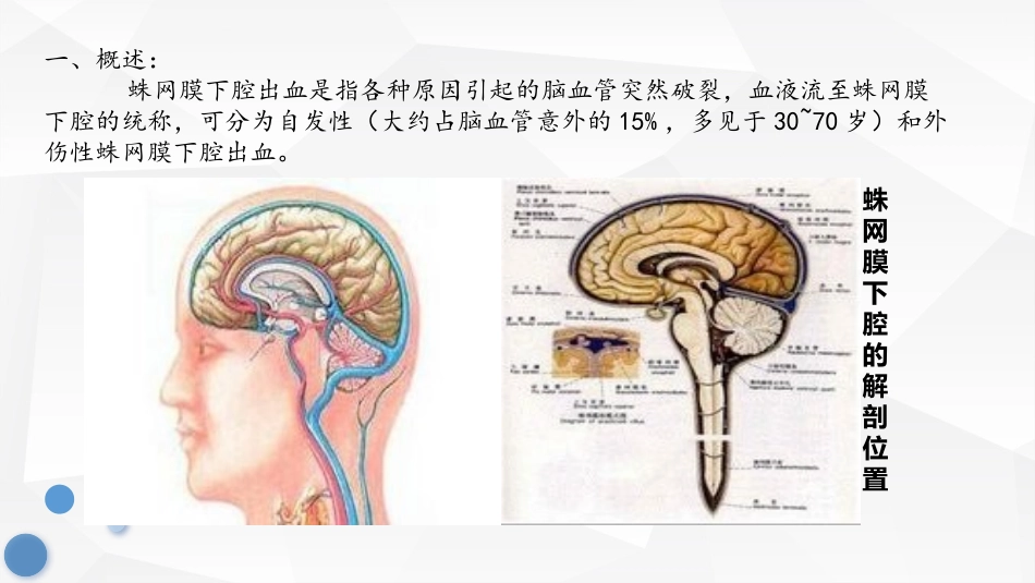 蛛网膜下腔出血的救治与护理_第2页