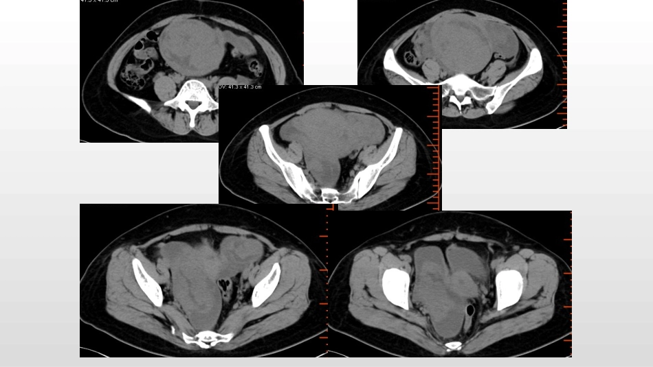 子宫肌瘤影像_第3页