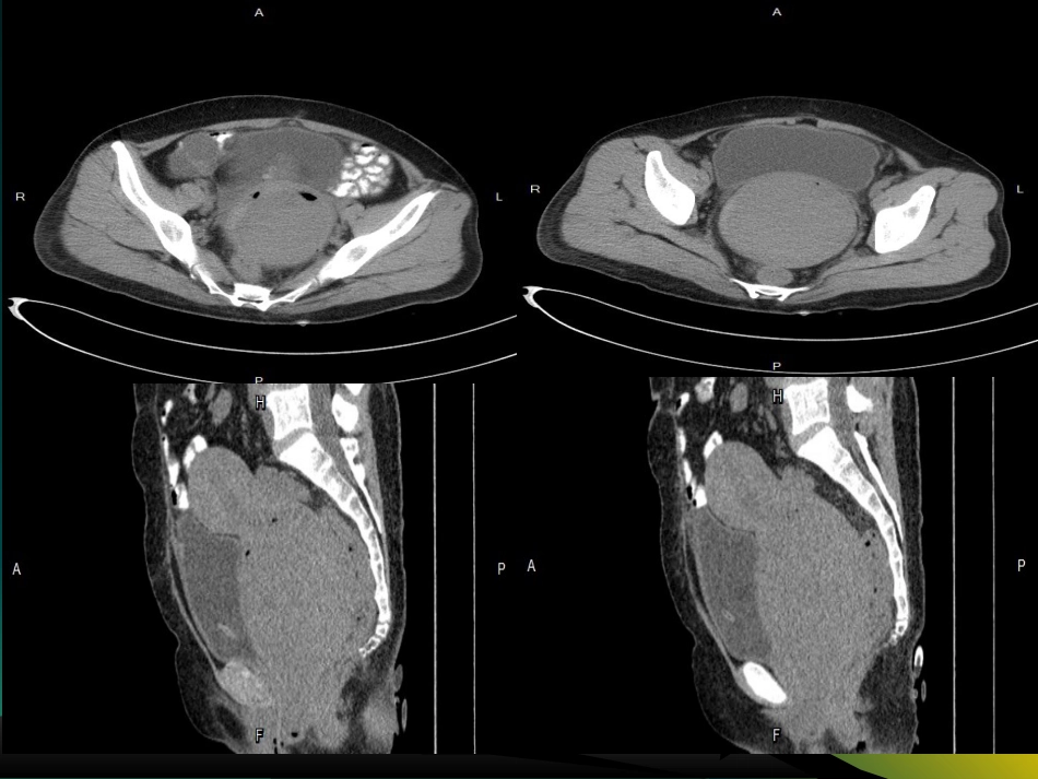 子宫肌瘤影像学诊断_第2页