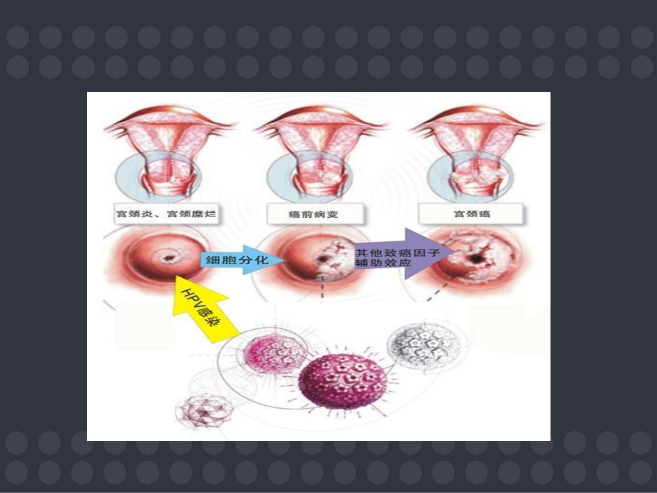 子宫颈癌前病变是什么_第3页