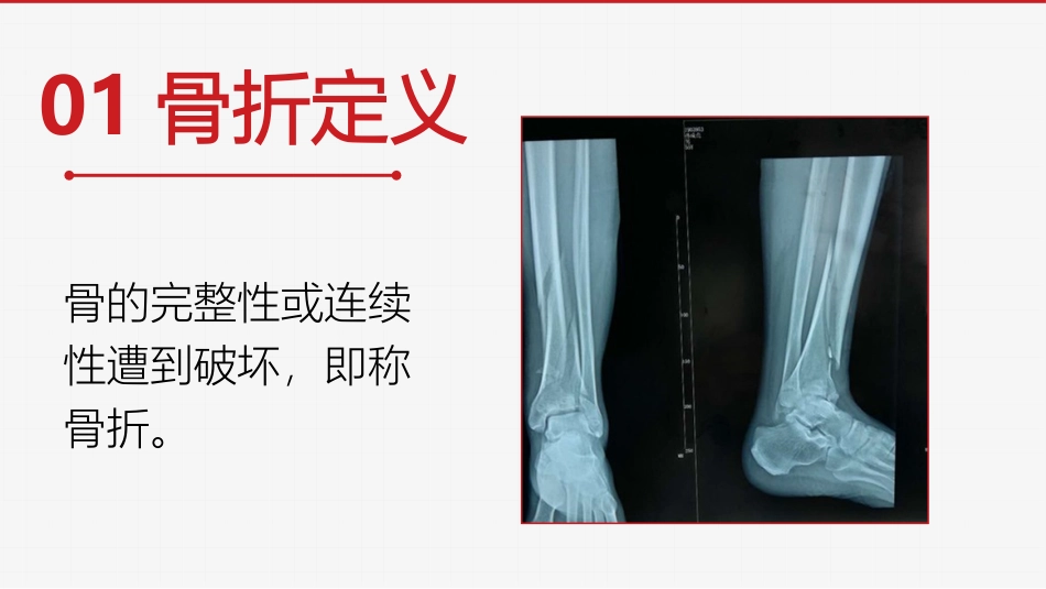 左胫骨远端骨折术后护理查房_第3页