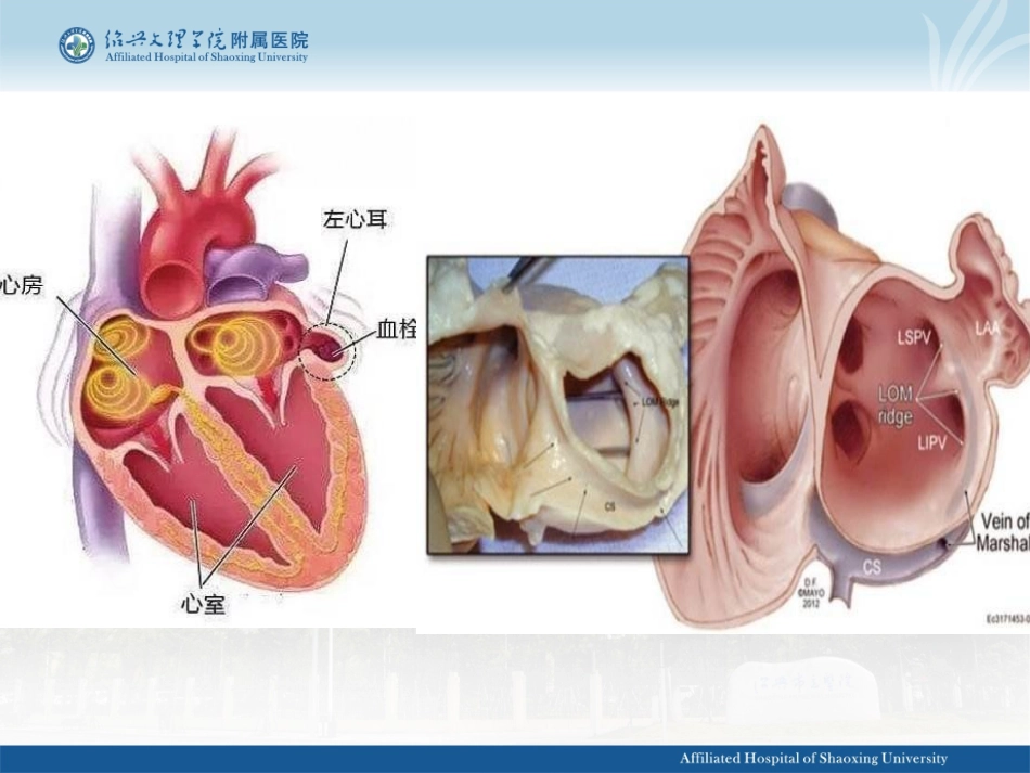 左心耳封堵术_第3页