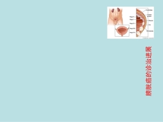 膀胱癌病例讨论