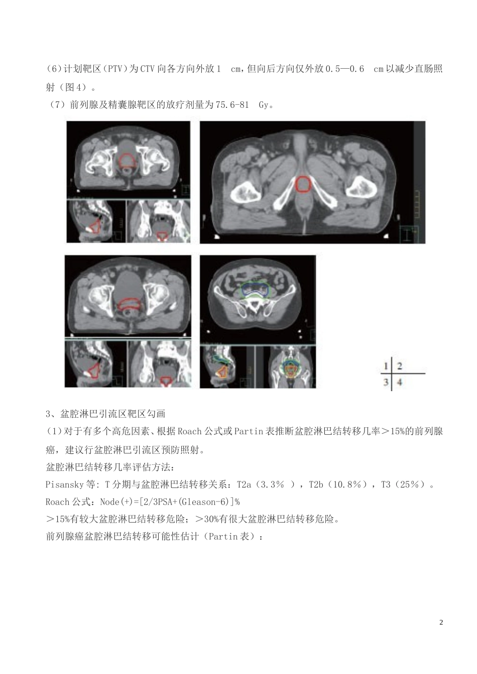 前列腺癌根治性放疗靶区_第2页
