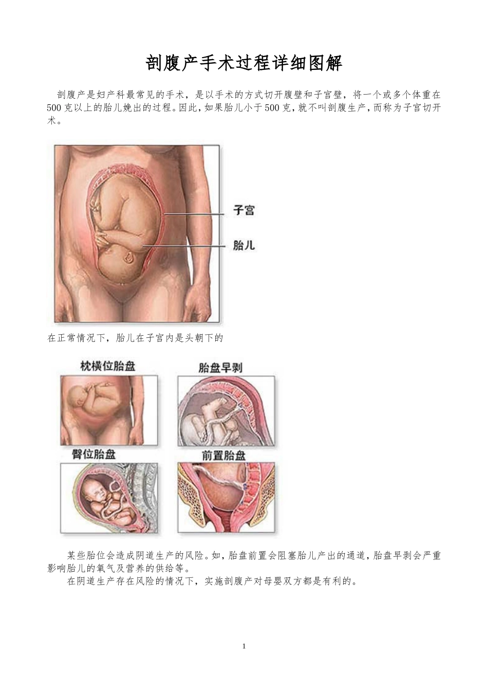 剖腹产手术过程详细图解_第1页