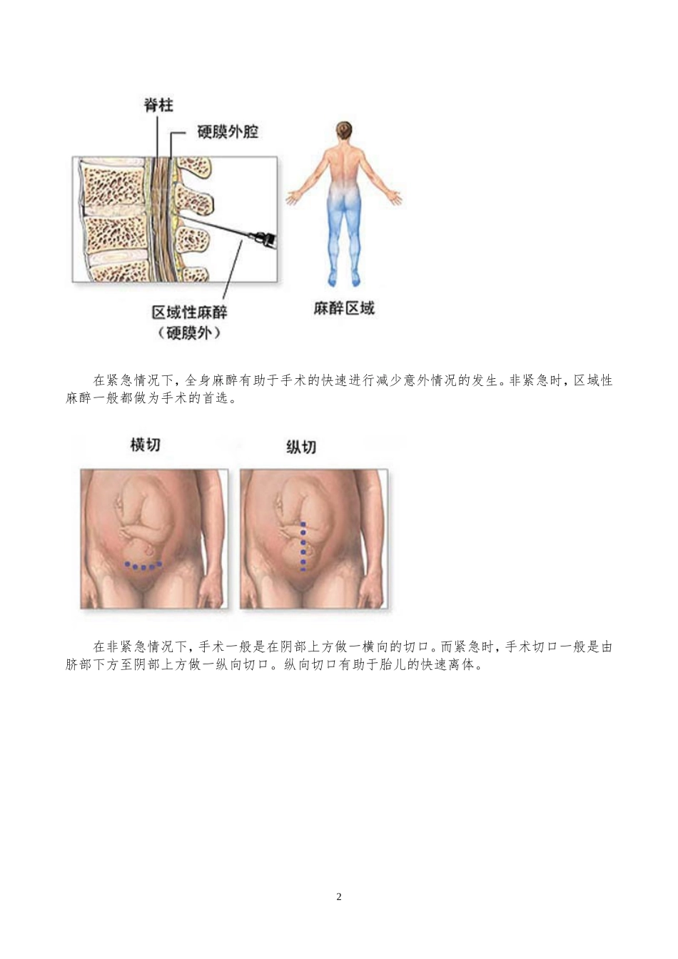 剖腹产手术过程详细图解_第2页