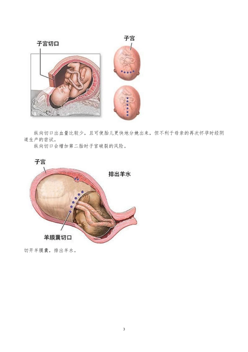 剖腹产手术过程详细图解_第3页