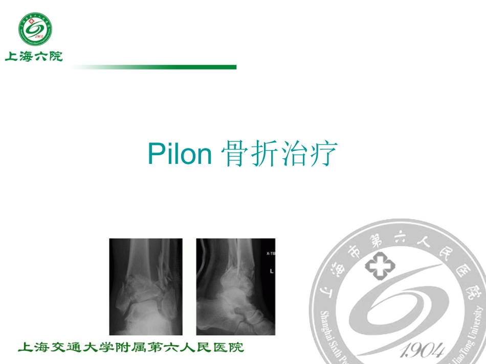Pilon骨折治疗_第1页