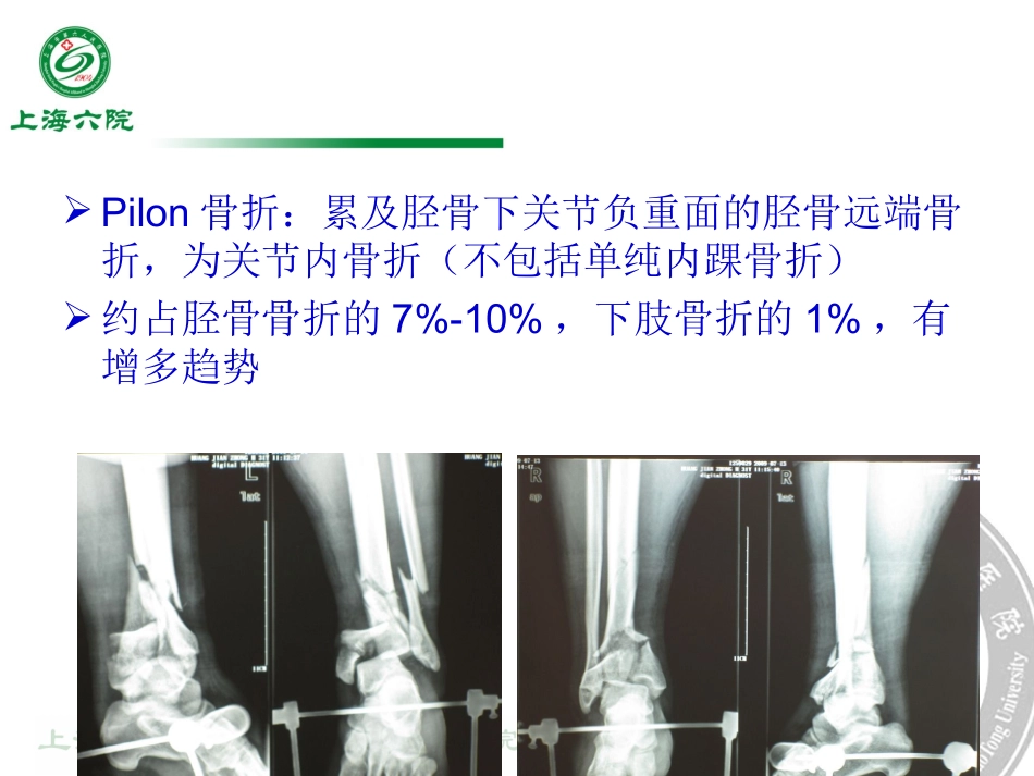 Pilon骨折治疗_第2页