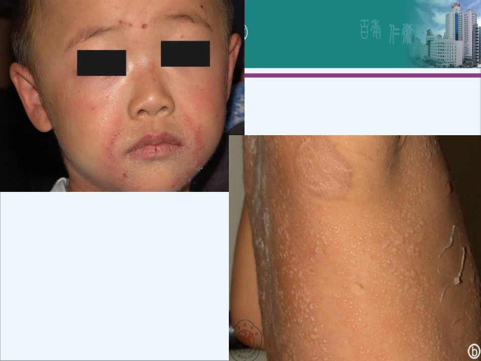 SSSS综合征_第2页