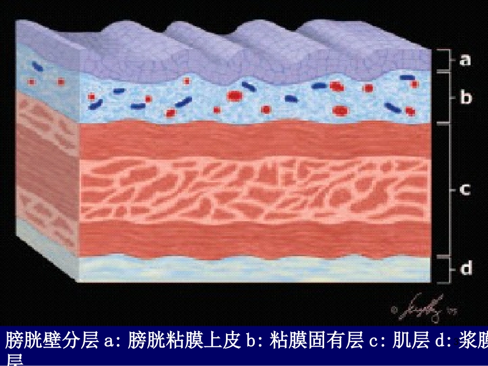 膀胱肿瘤影像诊疗医学课件_第3页