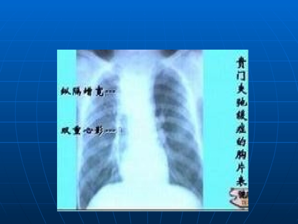 贲门失弛缓症_第3页