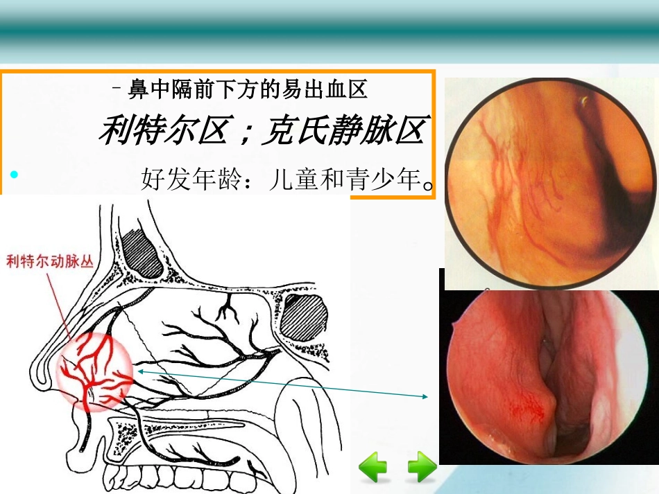 鼻出血尹兴红_第3页