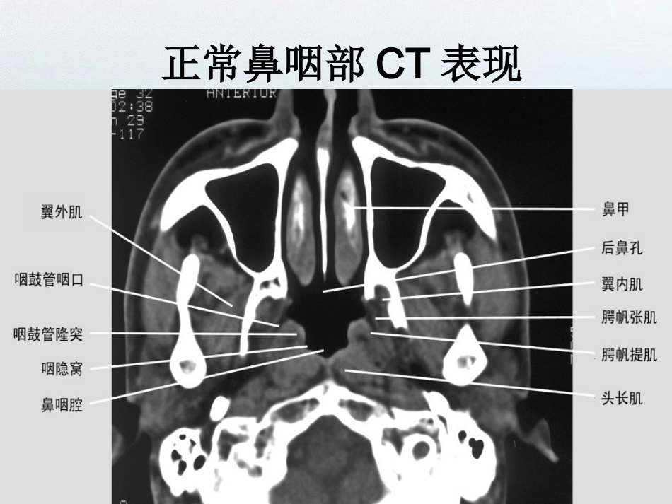 鼻咽部纤维血管瘤_第3页