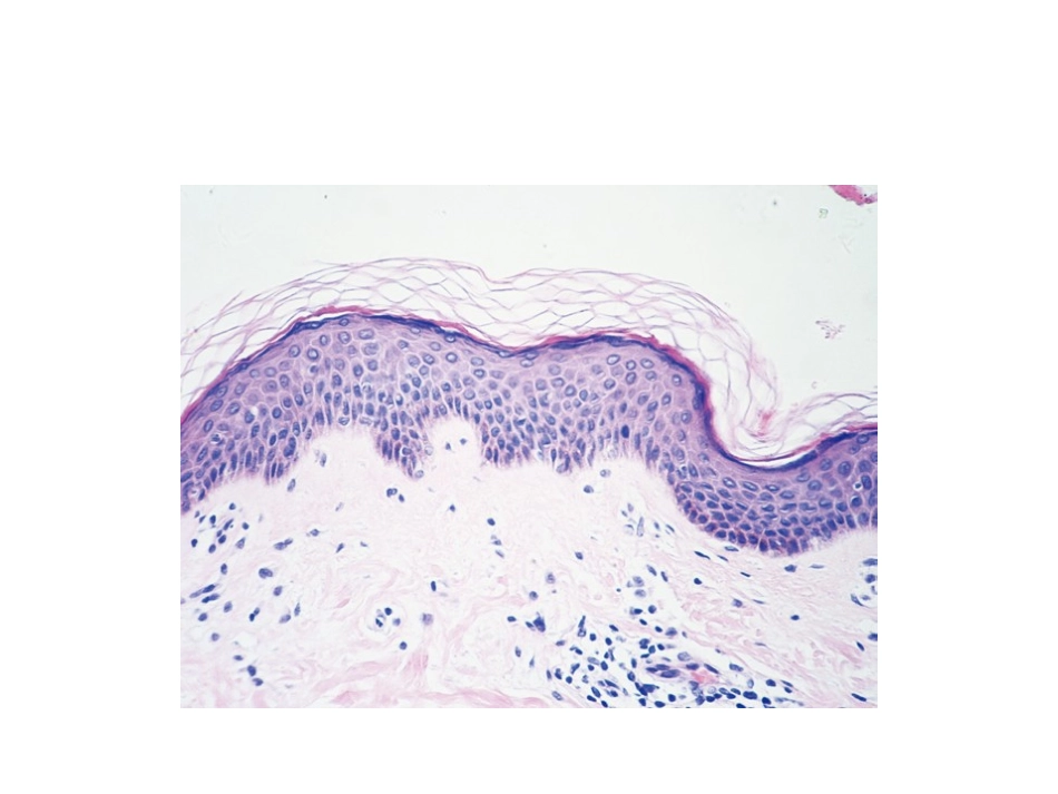 表皮病理变化_第3页