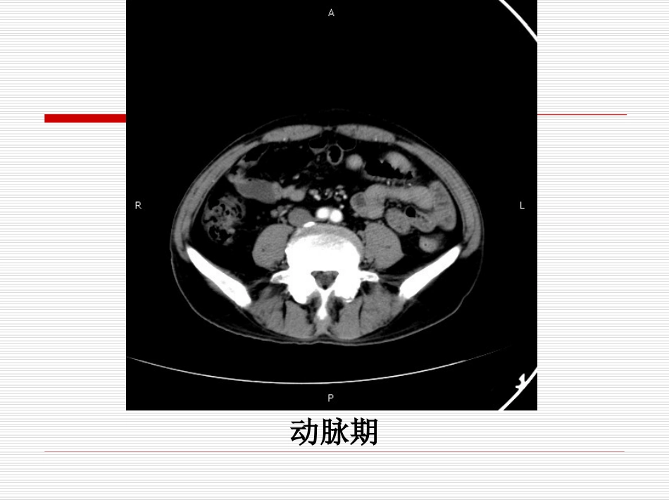 病例讨论胃间质瘤_第3页
