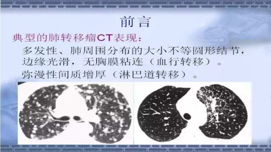 不典型肺转移瘤CT表现_第3页