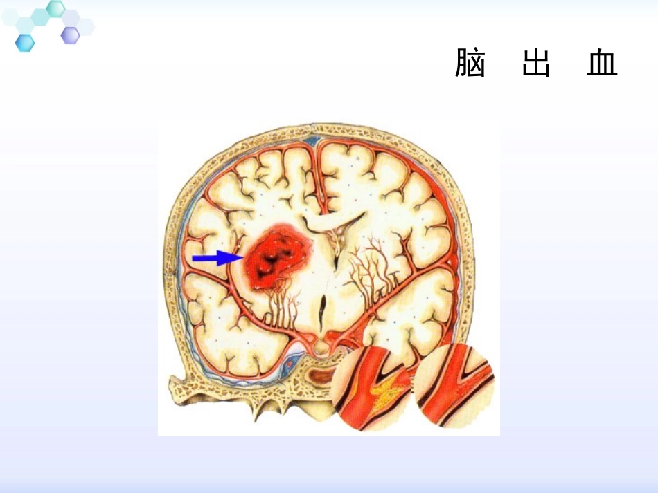 不同部位脑出血的评估和观察_第3页