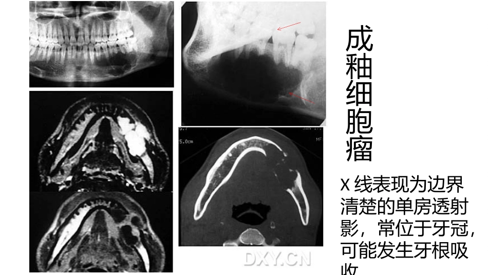 常见的口腔病例影像医学课件_第2页