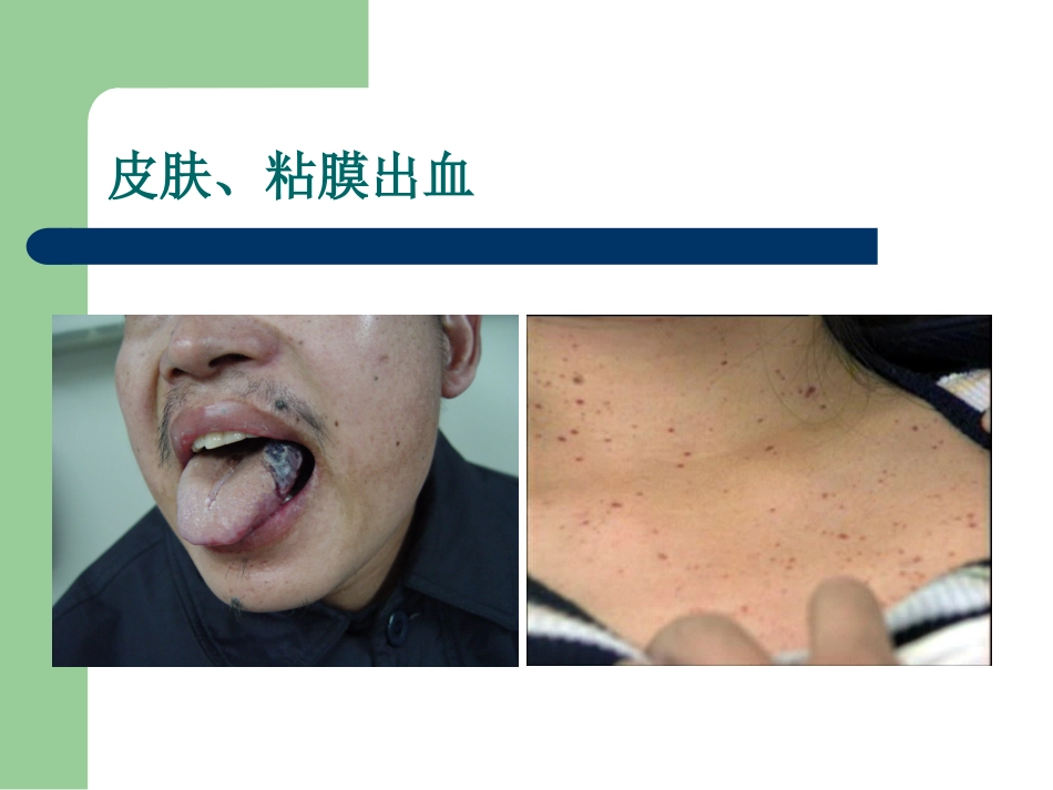 出血性疾病概述课件_第3页