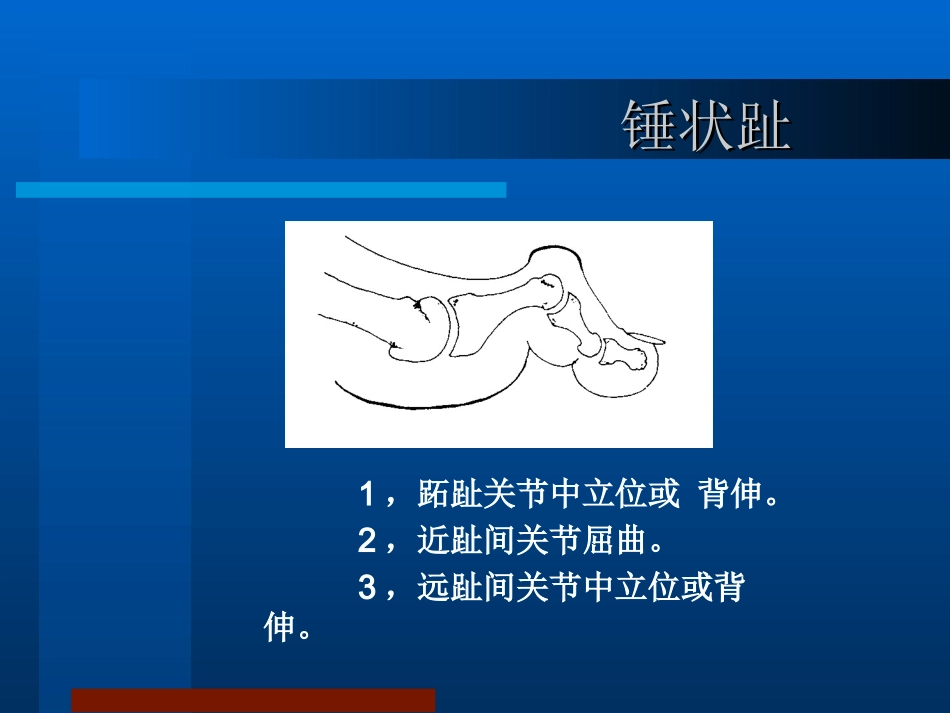 锤状趾槌状趾爪形趾_第2页