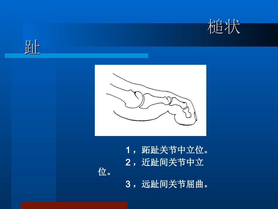 锤状趾槌状趾爪形趾_第3页