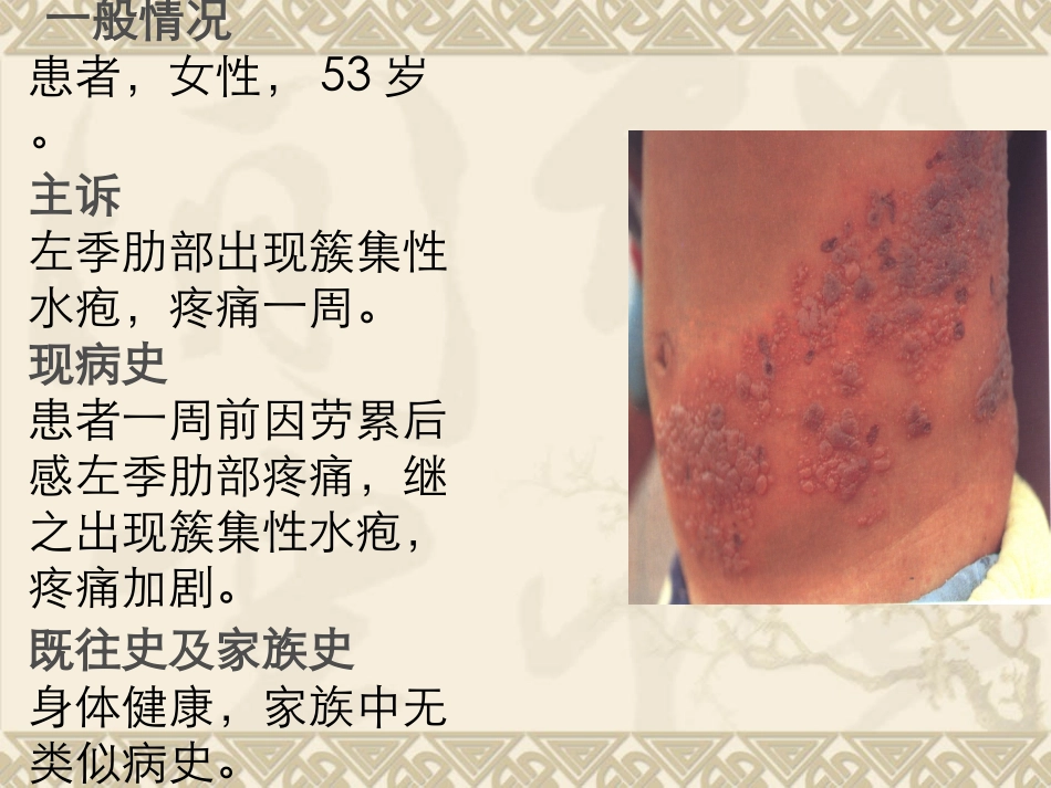 带状疱疹精选_第3页